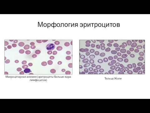 Макроцитарная анемия (эритроциты больше ядра лимфоцитов) Тельца Жоли Морфология эритроцитов