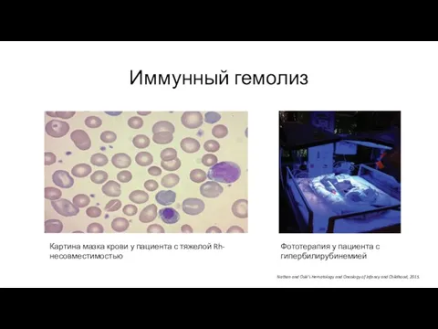 Иммунный гемолиз Nathan and Oski’s Hematology and Oncology of Infancy and Childhood,