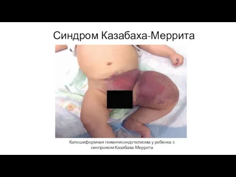 Синдром Казабаха-Меррита Капошиформная гемангиоэндотелиома у ребенка с синлромом Казабаха-Меррита