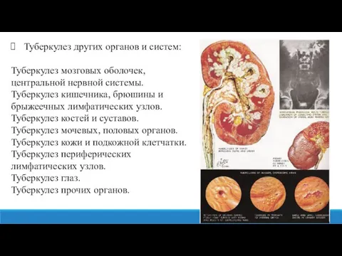 Туберкулез других органов и систем: Туберкулез мозговых оболочек, центральной нервной системы. Туберкулез