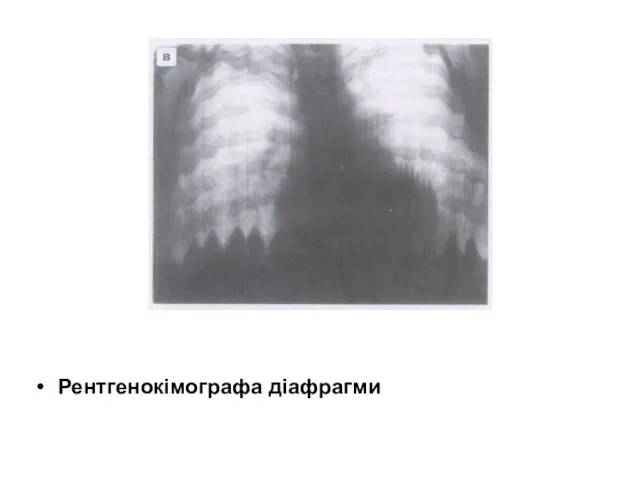 Рентгенокімографа діафрагми