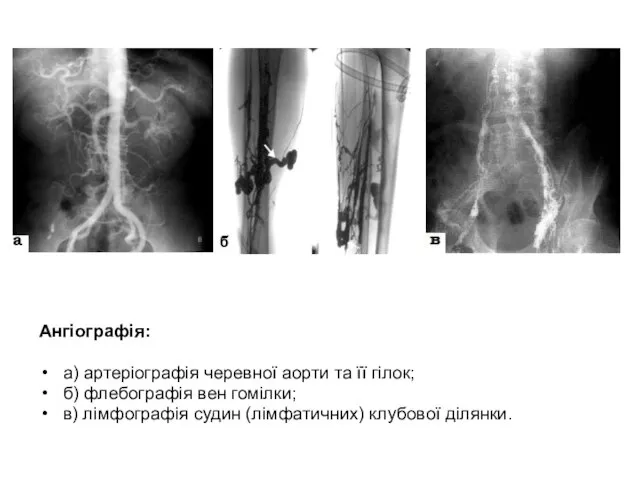 Ангіографія: а) артеріографія черевної аорти та її гілок; б) флебографія вен гомілки;