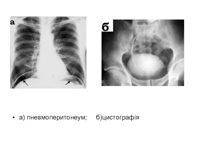 а) пневмоперитонеум; б)цистографія