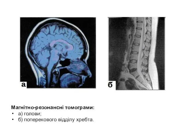 Магнітно-резонансні томограми: а) голови; б) поперекового відділу хребта.