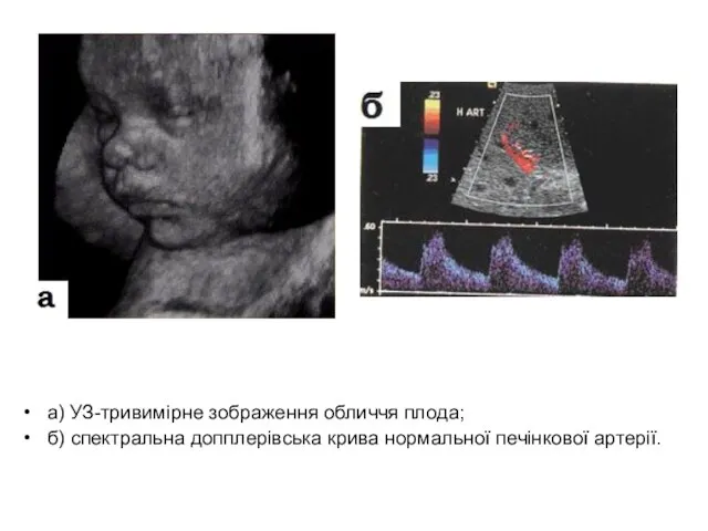а) УЗ-тривимірне зображення обличчя плода; б) спектральна допплерівська крива нормальної печінкової артерії.