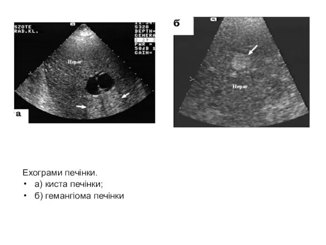 Ехограми печінки. а) киста печінки; б) гемангіома печінки