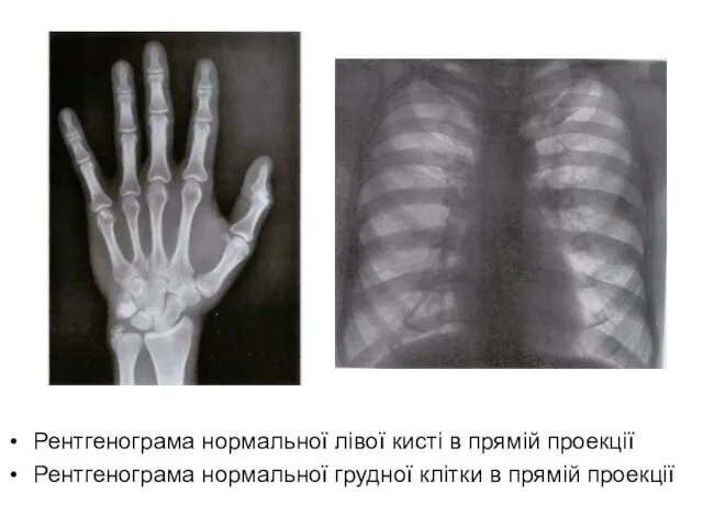 Рентгенограма нормальної лівої кисті в прямій проекції Рентгенограма нормальної грудної клітки в прямій проекції