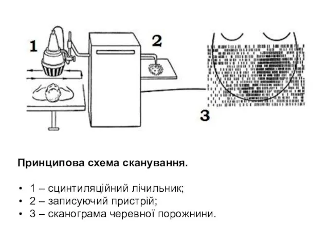 Принципова схема сканування. 1 – сцинтиляційний лічильник; 2 – записуючий пристрій; 3 – сканограма черевної порожнини.