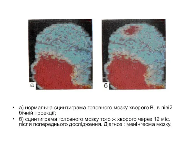 а) нормальна сцинтиграма головного мозку хворого В. в лівій бічній проекції; б)