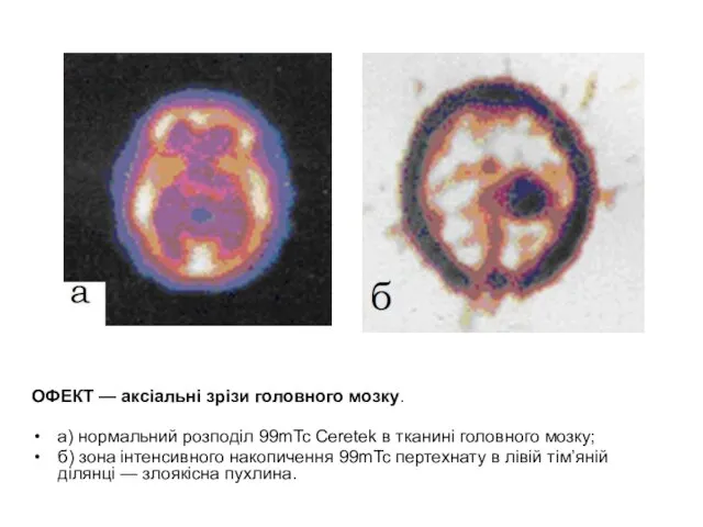 ОФЕКТ — аксіальні зрізи головного мозку. а) нормальний розподіл 99mTc Ceretek в