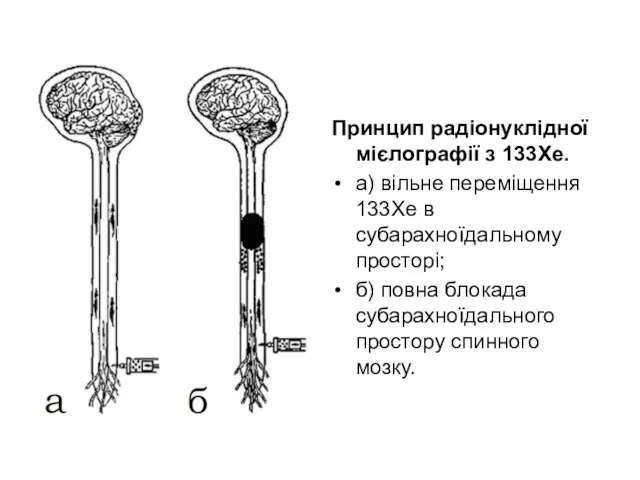 Принцип радіонуклідної мієлографії з 133Хе. а) вільне переміщення 133Хе в субарахноїдальному просторі;
