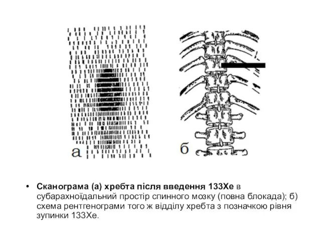 Сканограма (а) хребта після введення 133Хе в субарахноїдальний простір спинного мозку (повна