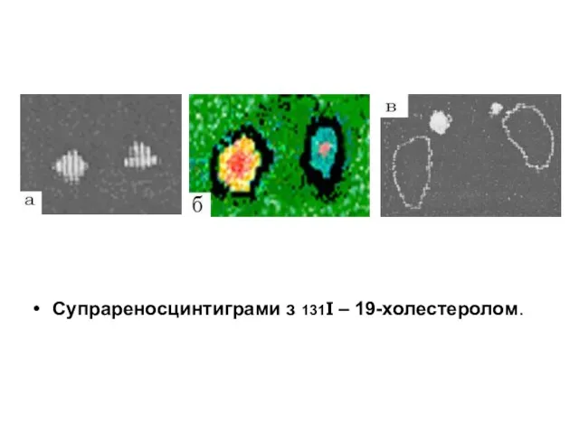 Супрареносцинтиграми з 131І – 19-холестеролом.