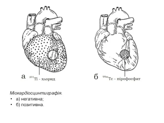 Міокардіосцинтиграфія. а) негативна; б) позитивна.