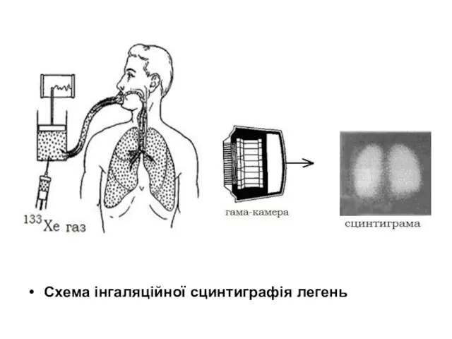 Схема інгаляційної сцинтиграфія легень