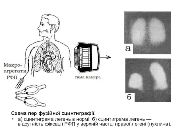 Схема пер фузійної сцинтиграфії. а) сцинтиграма легень в нормі; б) сцинтиграма легень