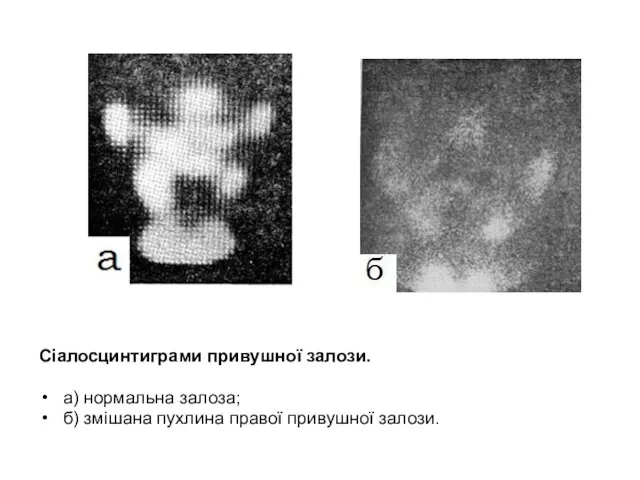 Сіалосцинтиграми привушної залози. а) нормальна залоза; б) змішана пухлина правої привушної залози.