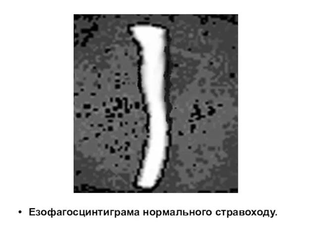 Езофагосцинтиграма нормального стравоходу.