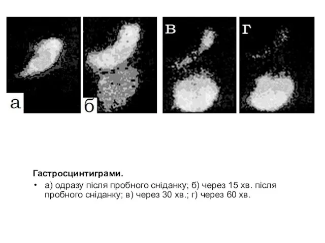 Гастросцинтиграми. а) одразу після пробного сніданку; б) через 15 хв. після пробного