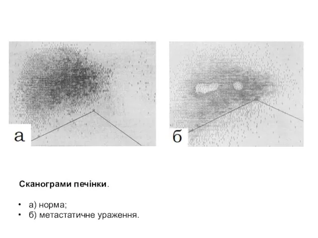 Сканограми печінки. а) норма; б) метастатичне ураження.