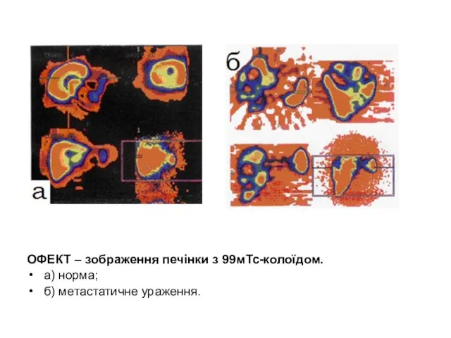 ОФЕКТ – зображення печінки з 99мТс-колоїдом. а) норма; б) метастатичне ураження.