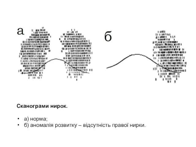 Сканограми нирок. а) норма; б) аномалія розвитку – відсутність правої нирки.