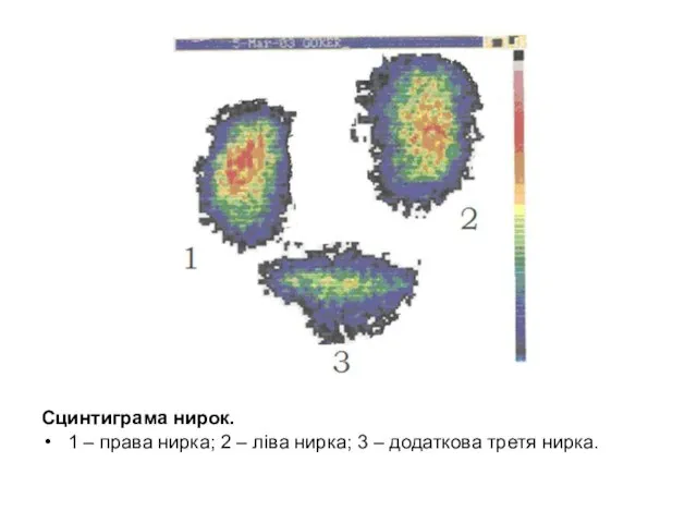 Сцинтиграма нирок. 1 – права нирка; 2 – ліва нирка; 3 – додаткова третя нирка.