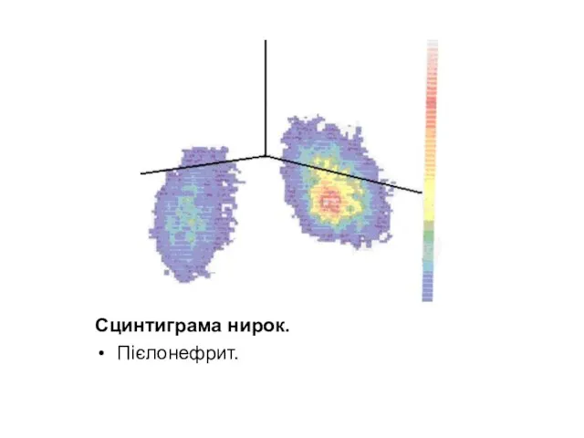 Сцинтиграма нирок. Пієлонефрит.