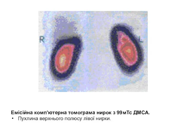 Емісійна комп’ютерна томограма нирок з 99мТс ДМСА. Пухлина верхнього полюсу лівої нирки.