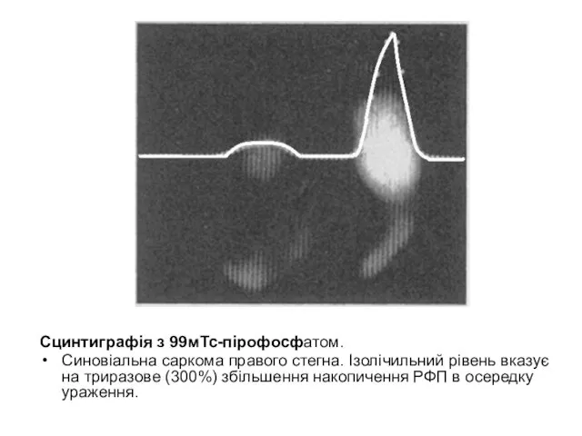 Сцинтиграфія з 99мТс-пірофосфатом. Синовіальна саркома правого стегна. Ізолічильний рівень вказує на триразове
