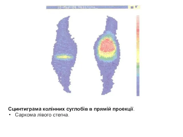 Сцинтиграма колінних суглобів в прямій проекції. Саркома лівого стегна.