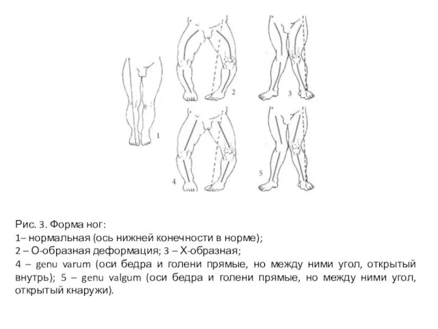 Рис. 3. Форма ног: 1– нормальная (ось нижней конечности в норме); 2