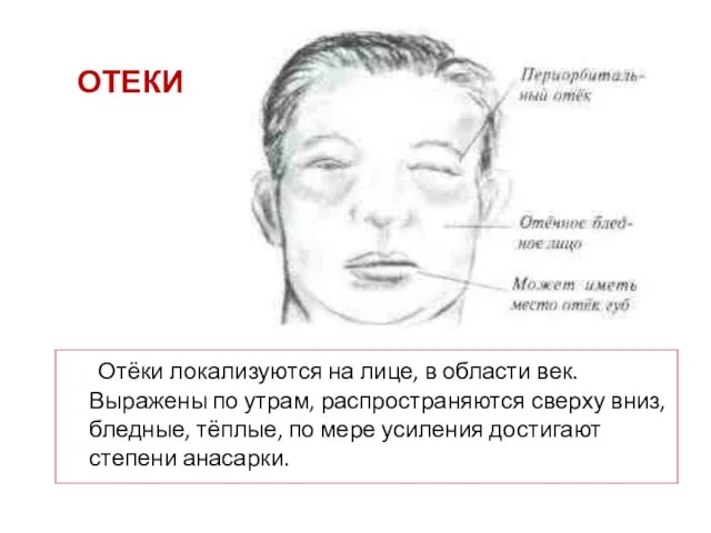 ОТЕКИ Отёки локализуются на лице, в области век. Выражены по утрам, распространяются