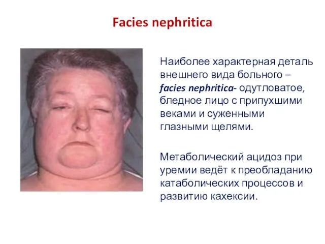 Facies nephritica Наиболее характерная деталь внешнего вида больного – facies nephritica- одутловатое,