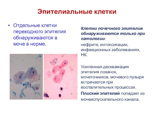 Эпителиальные клетки Отдельные клетки переходного эпителия обнаруживаются в моче в норме. Клетки