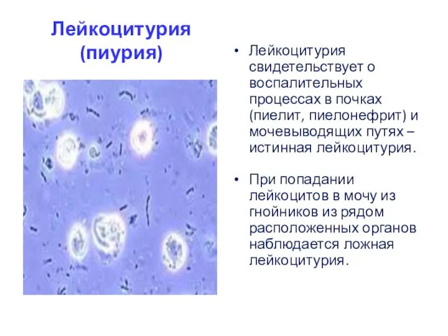 Лейкоцитурия (пиурия) Лейкоцитурия свидетельствует о воспалительных процессах в почках (пиелит, пиелонефрит) и