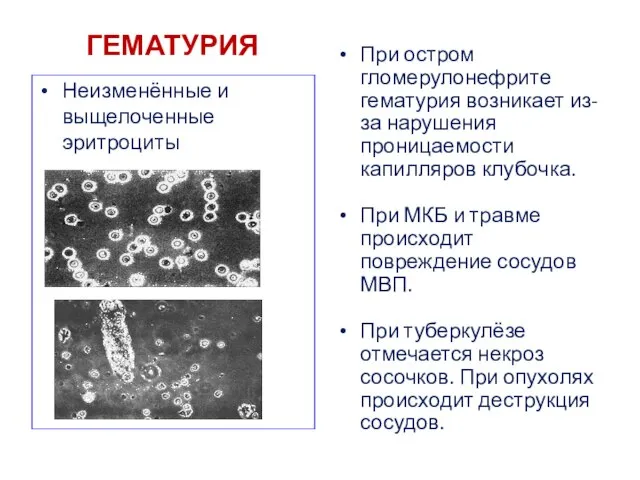 ГЕМАТУРИЯ Неизменённые и выщелоченные эритроциты При остром гломерулонефрите гематурия возникает из-за нарушения