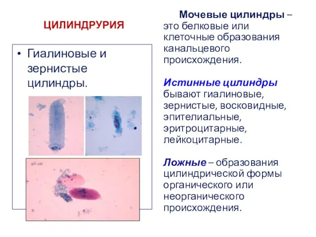 ЦИЛИНДРУРИЯ Гиалиновые и зернистые цилиндры. Мочевые цилиндры – это белковые или клеточные