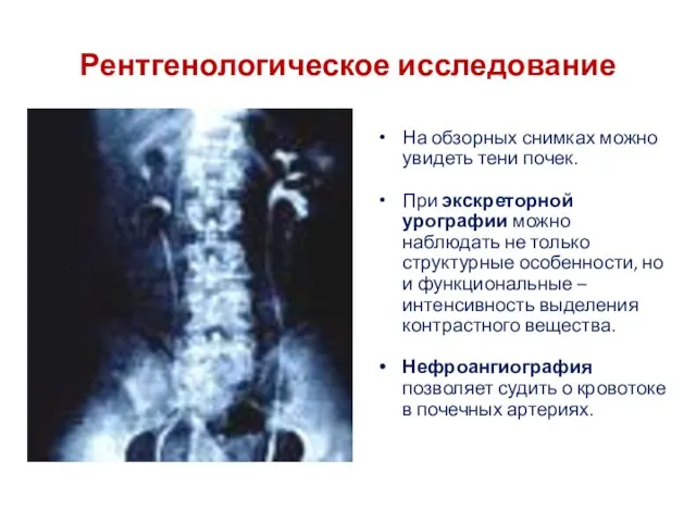 Рентгенологическое исследование На обзорных снимках можно увидеть тени почек. При экскреторной урографии