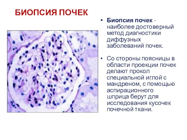 БИОПСИЯ ПОЧЕК Биопсия почек - наиболее достоверный метод диагностики диффузных заболеваний почек.