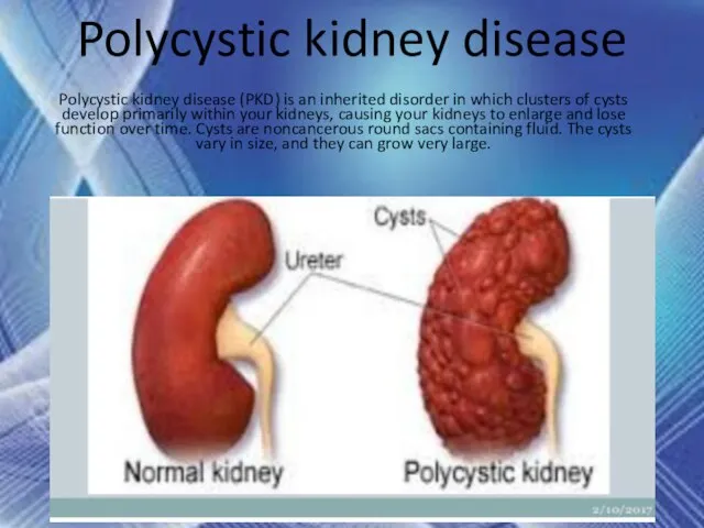 Polycystic kidney disease Polycystic kidney disease (PKD) is an inherited disorder in