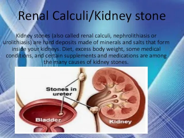 Renal Calculi/Kidney stone Kidney stones (also called renal calculi, nephrolithiasis or urolithiasis)
