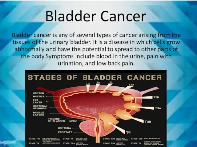 Bladder Cancer Bladder cancer is any of several types of cancer arising