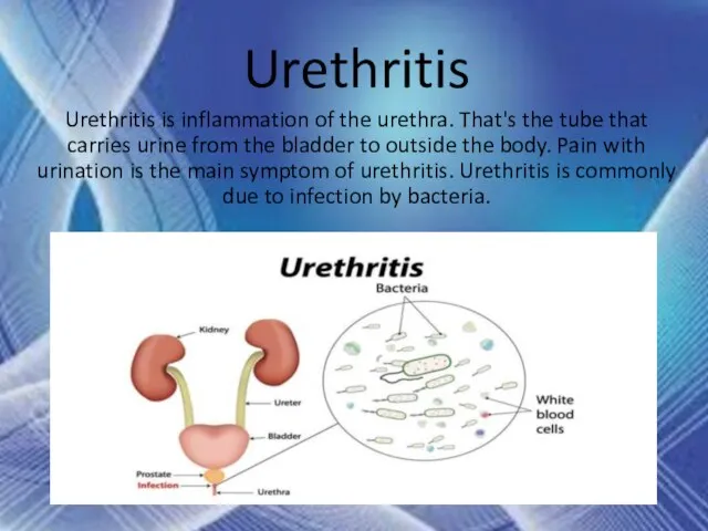 Urethritis Urethritis is inflammation of the urethra. That's the tube that carries