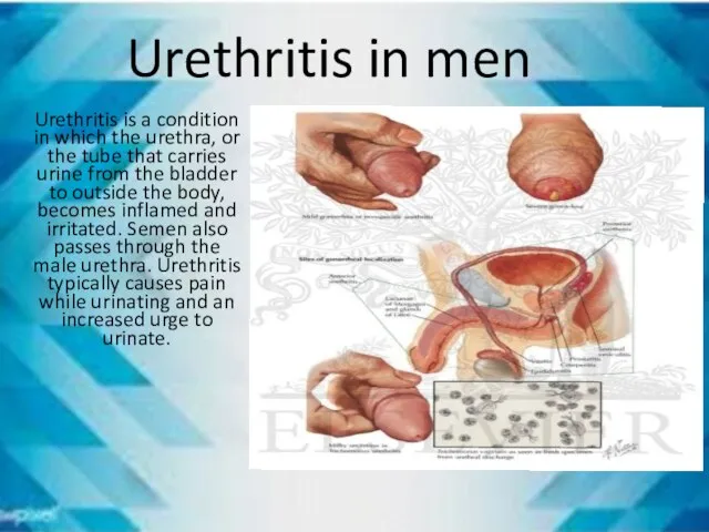 Urethritis in men Urethritis is a condition in which the urethra, or