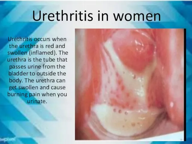 Urethritis in women Urethritis occurs when the urethra is red and swollen