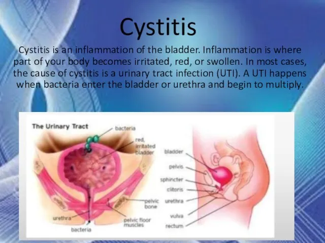 Cystitis Cystitis is an inflammation of the bladder. Inflammation is where part
