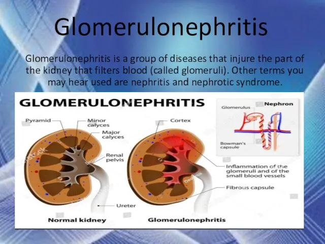 Glomerulonephritis Glomerulonephritis is a group of diseases that injure the part of