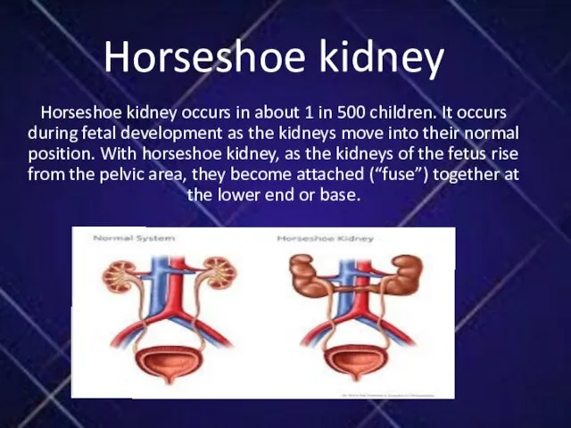 Horseshoe kidney Horseshoe kidney occurs in about 1 in 500 children. It