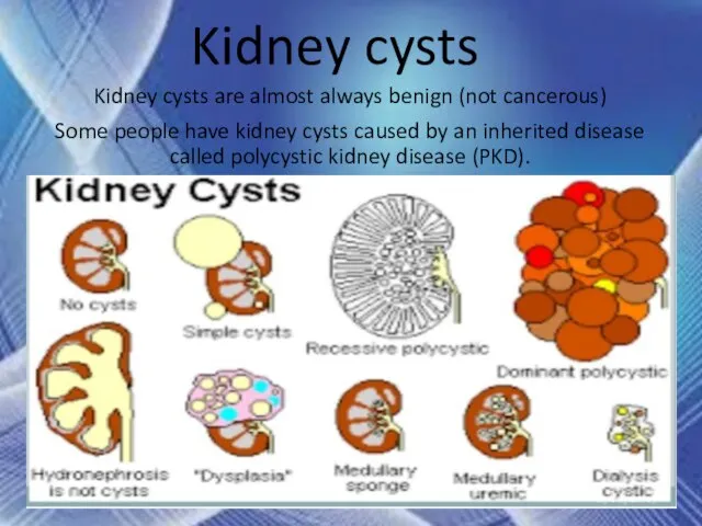 Kidney cysts Kidney cysts are almost always benign (not cancerous) Some people